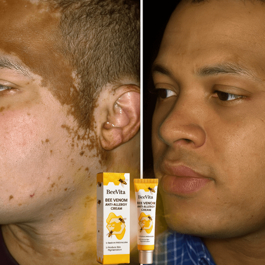 Before and after images showcasing BeeVita Anti-Allergy Cream effectiveness on irritated skin.
