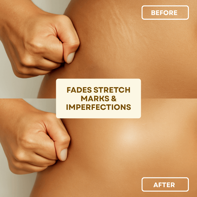 Before and after image showing results of body treatment that fades stretch marks and imperfections.
